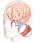 Cơ quan Quản lý Dược phẩm Anh (MHRA): Cảnh báo Hội chứng bệnh não sau và hội chứng co thắt mạch máu não khi sử dụng pseudoephedrin